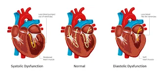 Heart Muscle Dysfunction