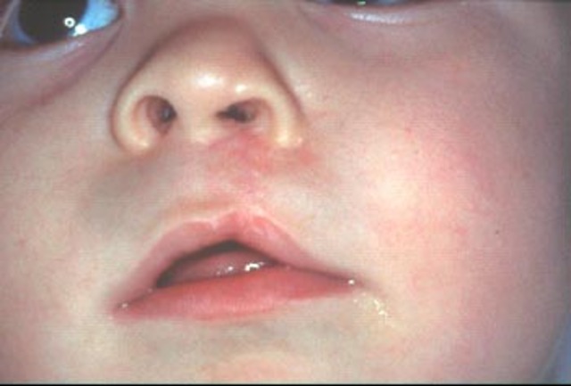 Operación de labio leporino