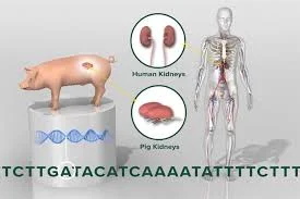 Trasplante de riñón de cerdo editado genéticamente a humano.