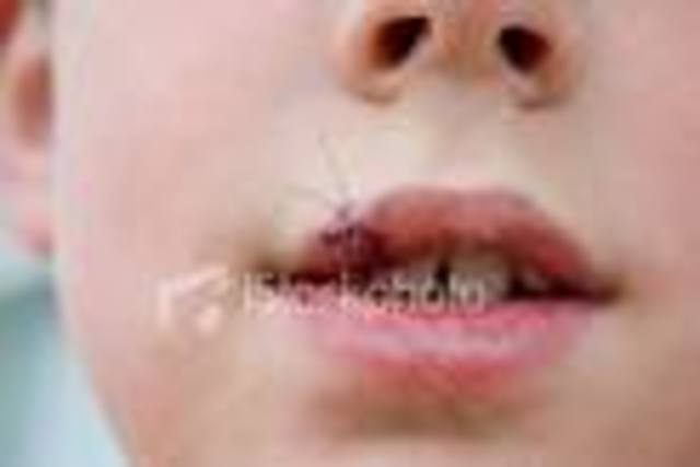 The Fist time I got stitches