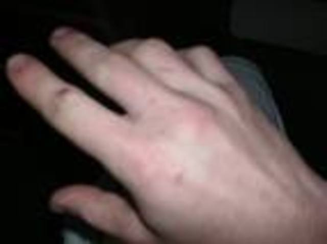 whene my sister brocke her nuckle