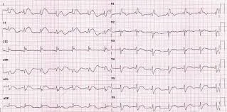 Primer electrocardiograma