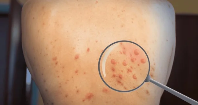 Primera vacuna contra la viruela