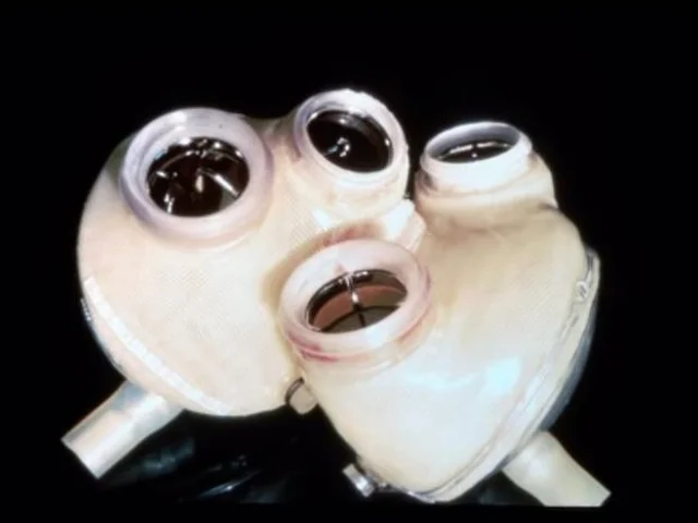 Se utilizar por primera vez un órgano artificial.