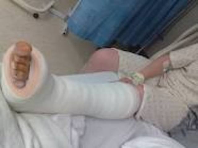 Broken ankle