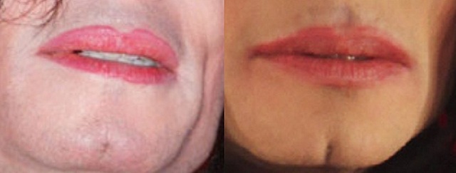 Michael gets surgery done to put a cleft into his chin.