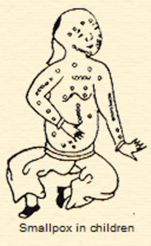 Tibetian Statesman Wang Tan uses ground smallpox scabs to inoculate his one surviving child