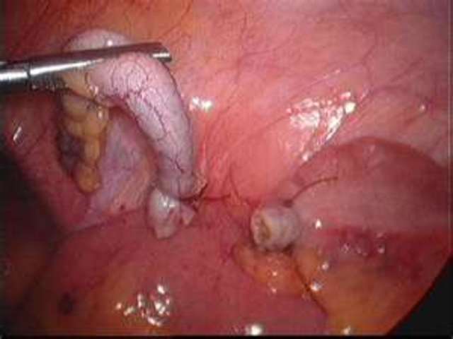 I got surgury for my Appendix