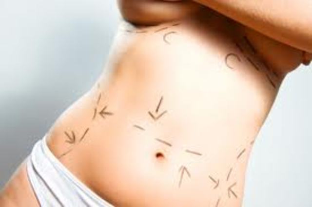 liposuction