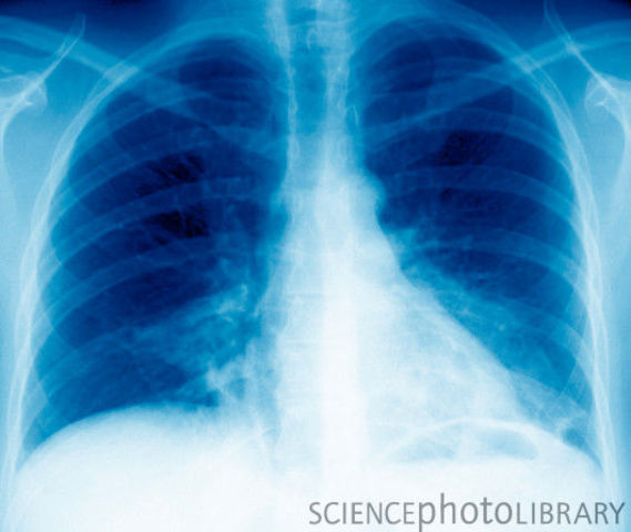 Legionnaire’s Disease hit 182, killed 29