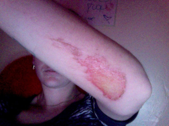 Got into my first horse back riding accident