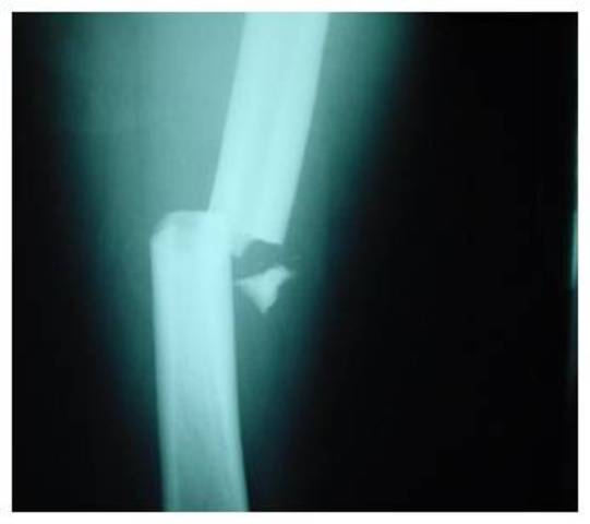 Me caí de un cuarto piso