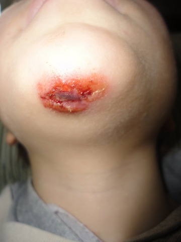 I busted my chin open on the stairs