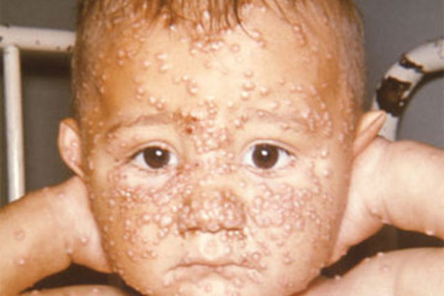 Smallpox Infection