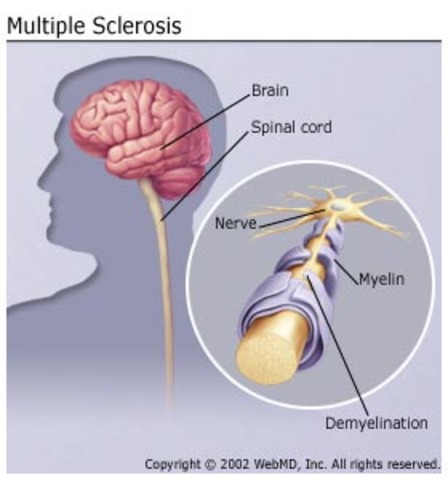 Mother & Sclerosis
