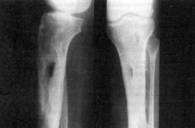 Secuelas de mi caida