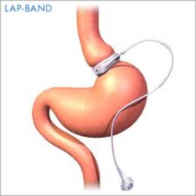 Timeline: History of the Lap-Band