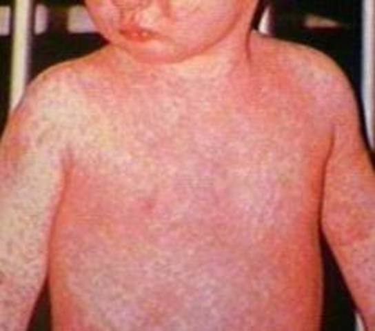 Measles Vaccine
