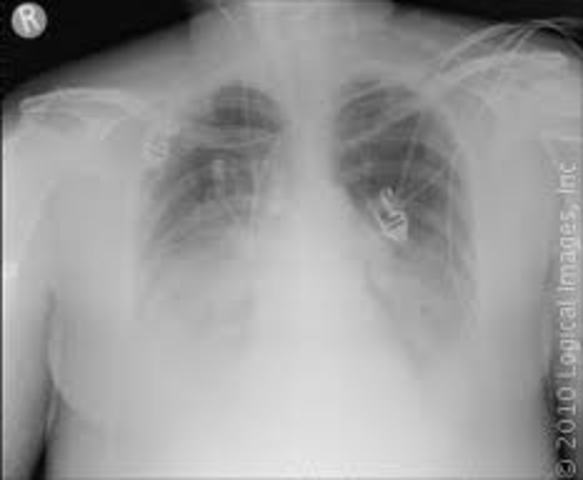 Legionnaire’s Disease Strikes