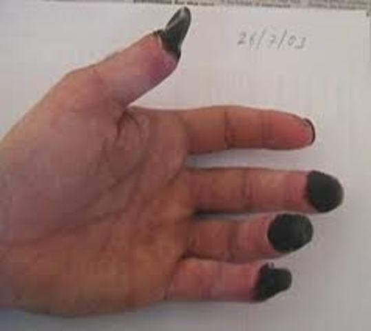 One member gets frostbite..