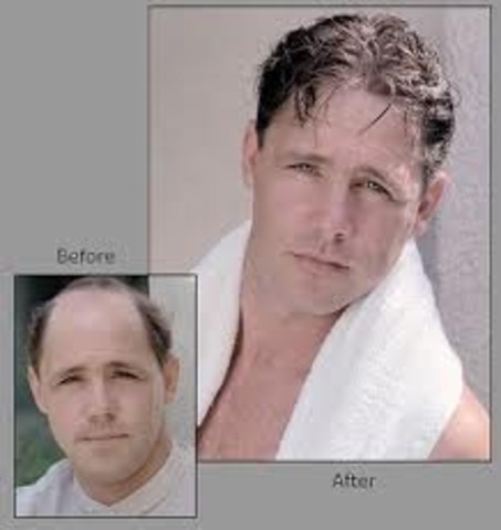 A baldness treatment was invented