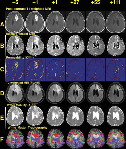 Normalization of glioblastoma vasculature in patients