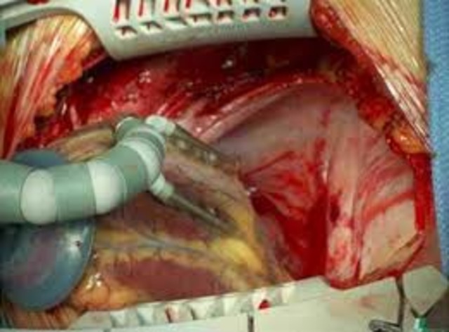 first open heart surgery. scientific discoveries 1895