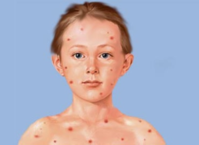 measles vaccine