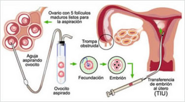 Primera fecundacion in vitro