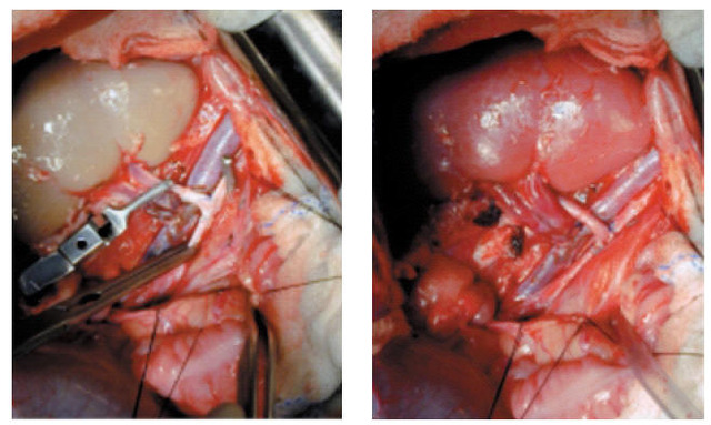 Primer xenotrasplante
