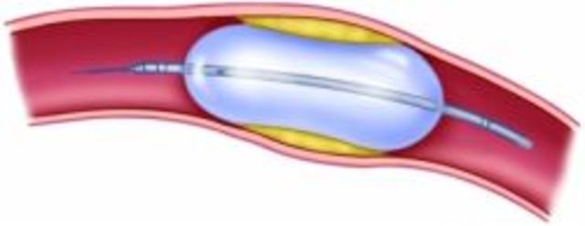 Sciene and Technology: Balloon Angioplasty