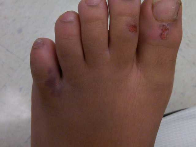 MY Broken Toe