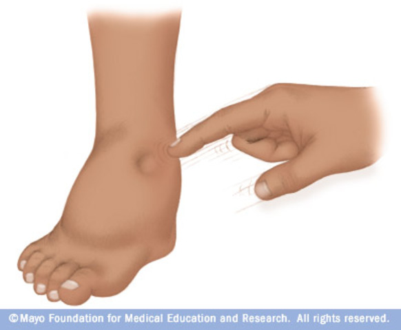 Nawang sick with edema, very sick