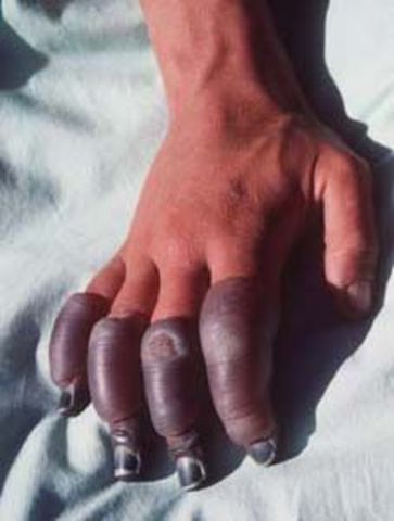 Nawang is sick with edema.