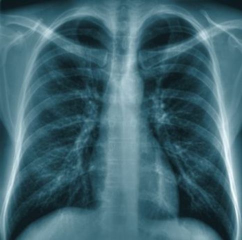 First X-Ray Treats Breast Cancer