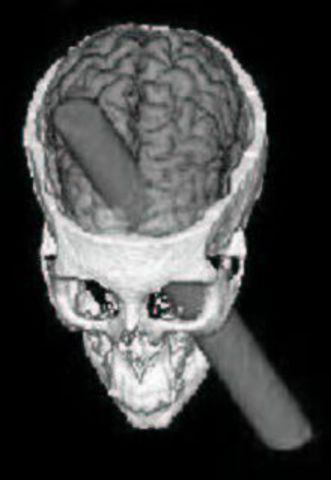 ACCIDENTE DE PHINEAS GAGE