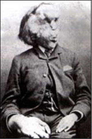 Joseph Merrick "The Elephant Man" is born in Leicester, England