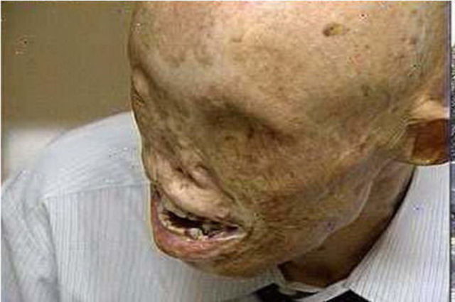 Second Atomic Bomb Dropped on Nagasaki