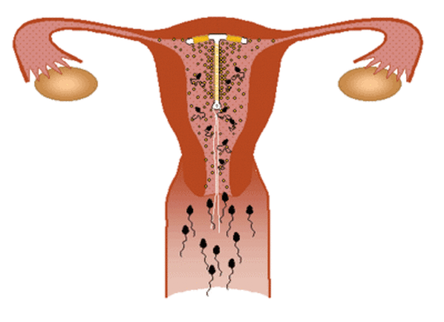 Dispositivo intrauterino
