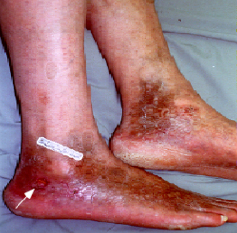 Nawang sick with edema, very sick.