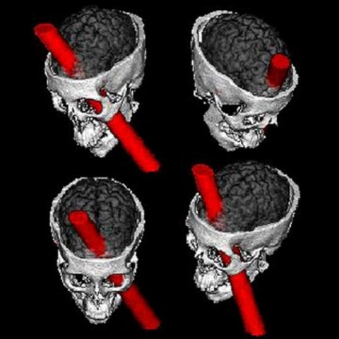 El dolor de Cabeza de Phineas Gage
