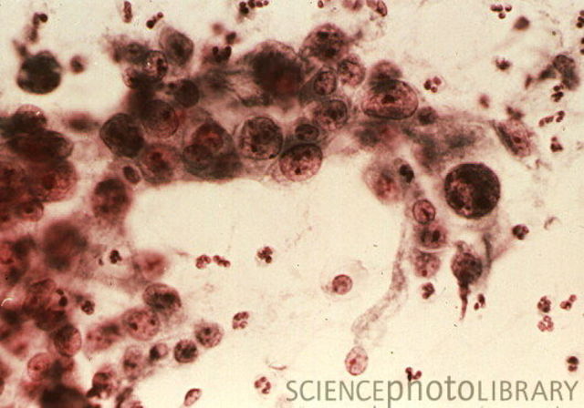 Henrietta finds out her cancer is malignant