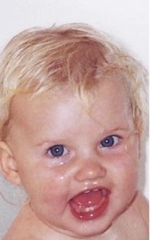 When my face caught fire