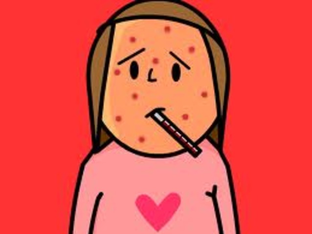 Chicken pox