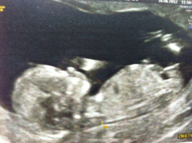 2eme écho 13SA HIBISCUS