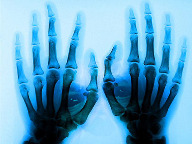 The X-ray is Invented