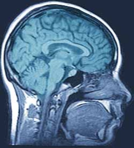 1941년, 과잉행동과 뇌손상 관련성 지적