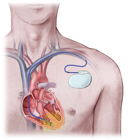 Implantable cardioverter defibrillator