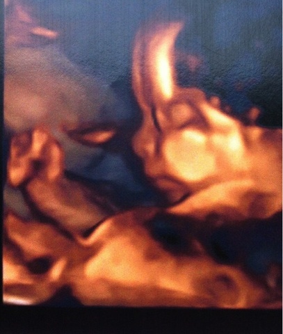 écho morphologique HIBISCUS