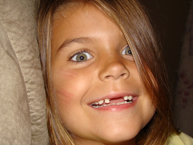 I lost my 2 front teeth for Christmas